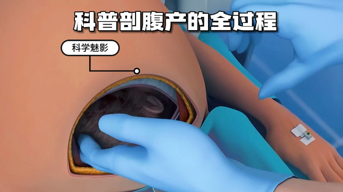 夢見剖腹產的深層解析：從傳統解夢到現代心理學的啟示相关图片
